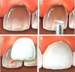 Dental Veneers - Dr Kenneth Chae