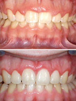 Laser Gingivectomy - Elmwood Park