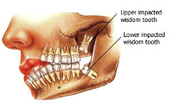 Wisdom Teeth Extractions - Elmwood Park