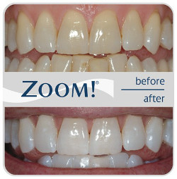 Zoom Teeth Whitening - Elmwood Park