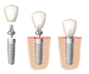 Dental Implants by Dr. Kenneth Chae